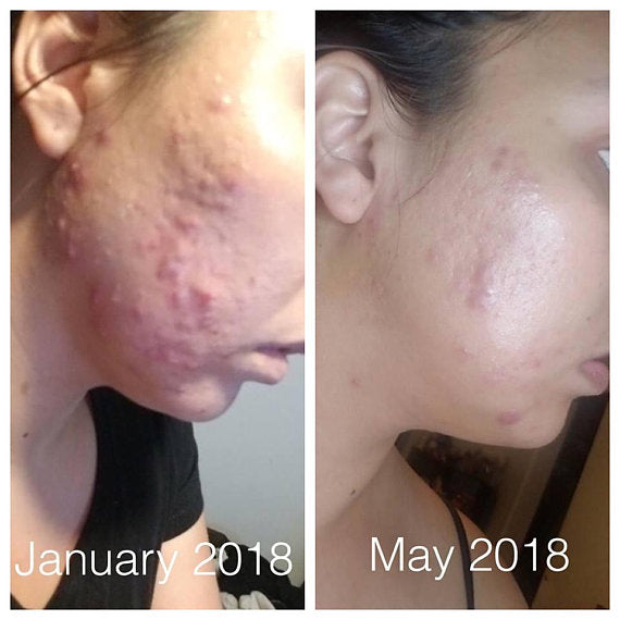Side-by-side comparison of a person's cheek with acne from January 2018 and May 2018, showing significant improvement in skin clarity and reduction of inflammation over time, thanks to White Smokey's effective Super Acne Fighter Organic Acne Treatment.