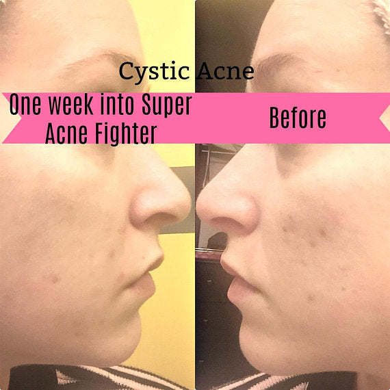 Side-by-side images of the same person's cheek, labeled "Cystic Acne." The right image shows "Before," and the left image shows "One week into Organic Acne Treatment." Visible improvement is noted, thanks to this acne-fighting serum by White Smokey.
